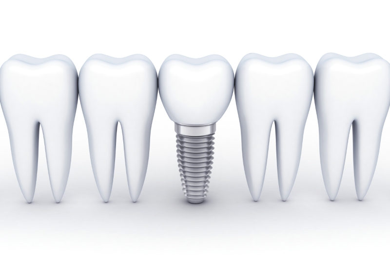 インプラントのメリット